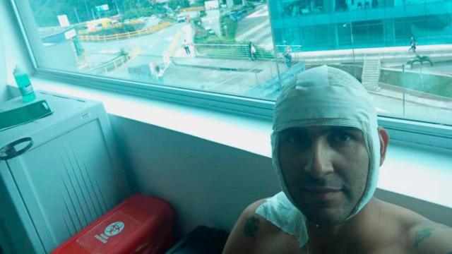 En la unidad de quemados permanece hombre que le estallo un volador en el cuello