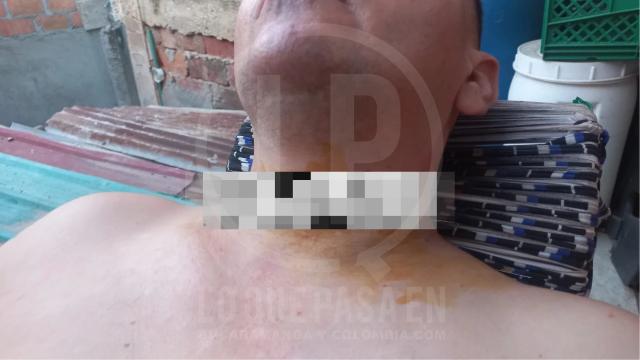 Motociclista sufrió grave accidente por una cuerda de cometa en Campo Hermoso