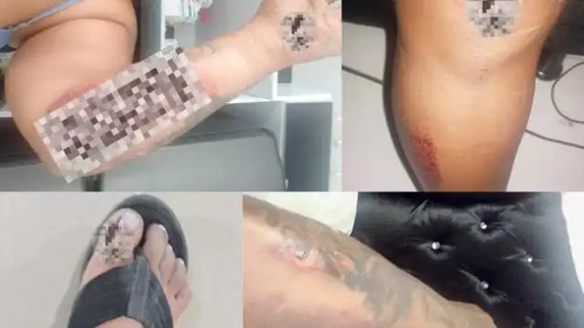 Motociclista se accidentó en Tránsito en Girón, denuncia falta de atención.