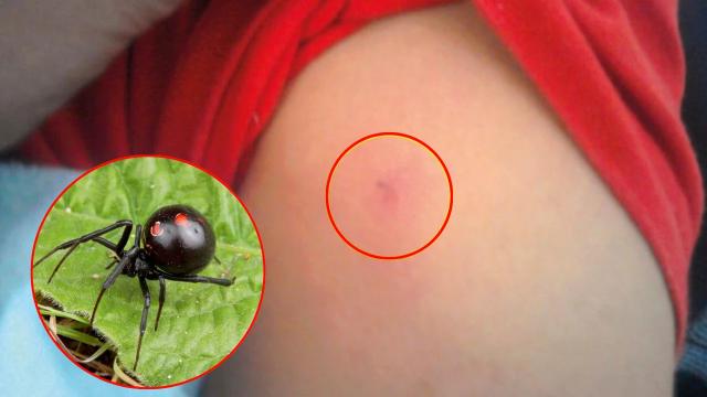 Tragedia: Niño de 13 años murió luego de ser picado por una araña