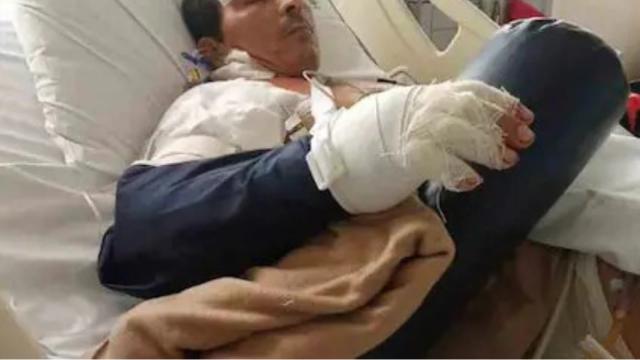 Campesino por poco pierde su brazo tras brutal accidente con motosierra